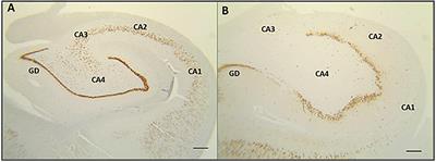 Do Hippocampal Neurons Really Count for Comorbid Depression in Patients With Mesial Temporal Lobe Epilepsy and Hippocampal Sclerosis? A Histopathological Study